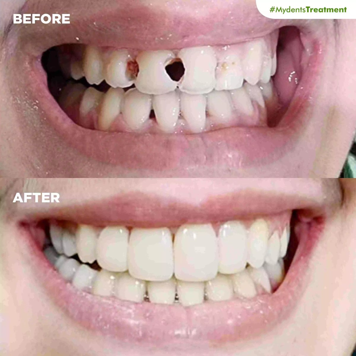 Mengatasi gigi goyang agar kuat kembali