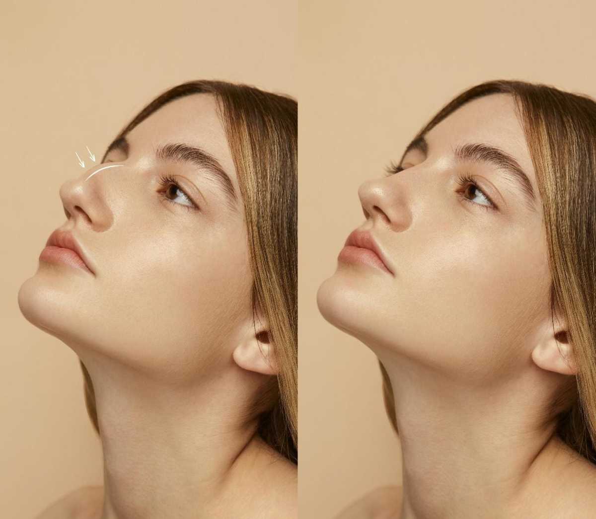 Hidung tersumbat tapi tidak pilek